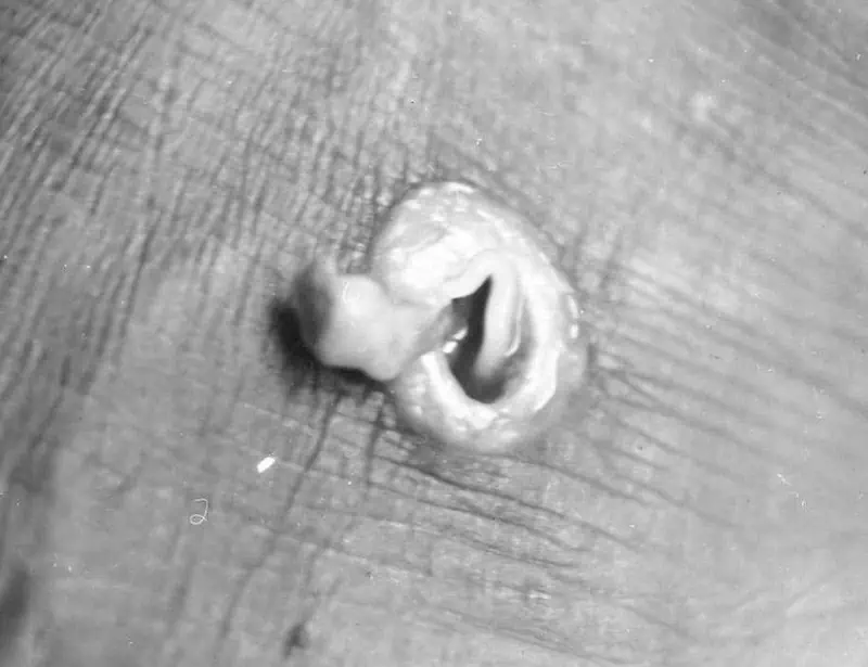 guinea worm